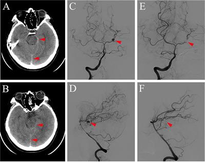 Case Report: Migraine-Like Headache With Visual Aura Initiated by Endovascular Coiling Treatment for a Posterior Cerebral Artery Aneurysm